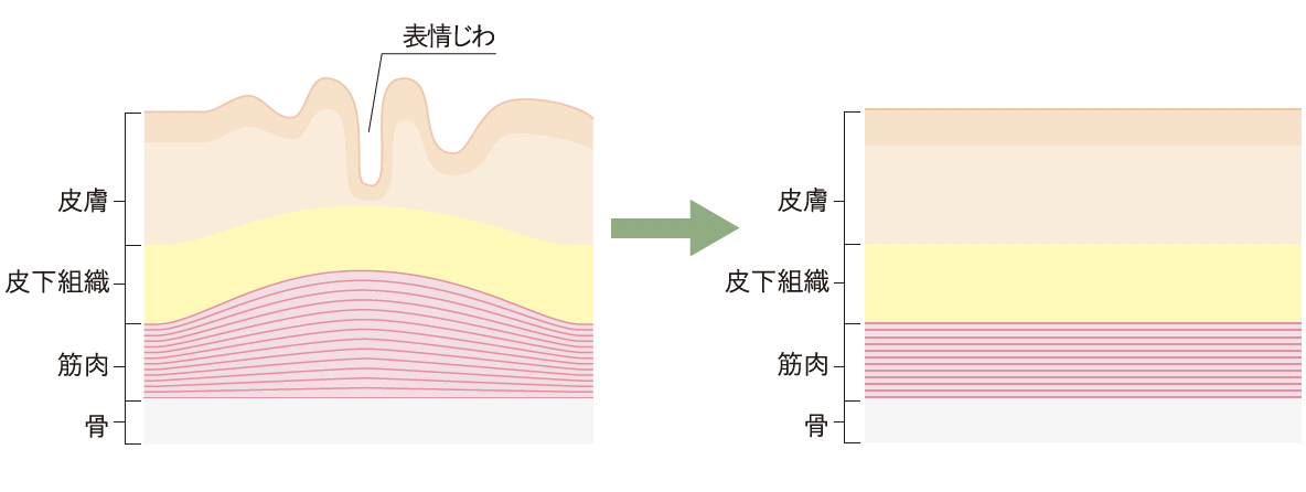 肉毒素治疗