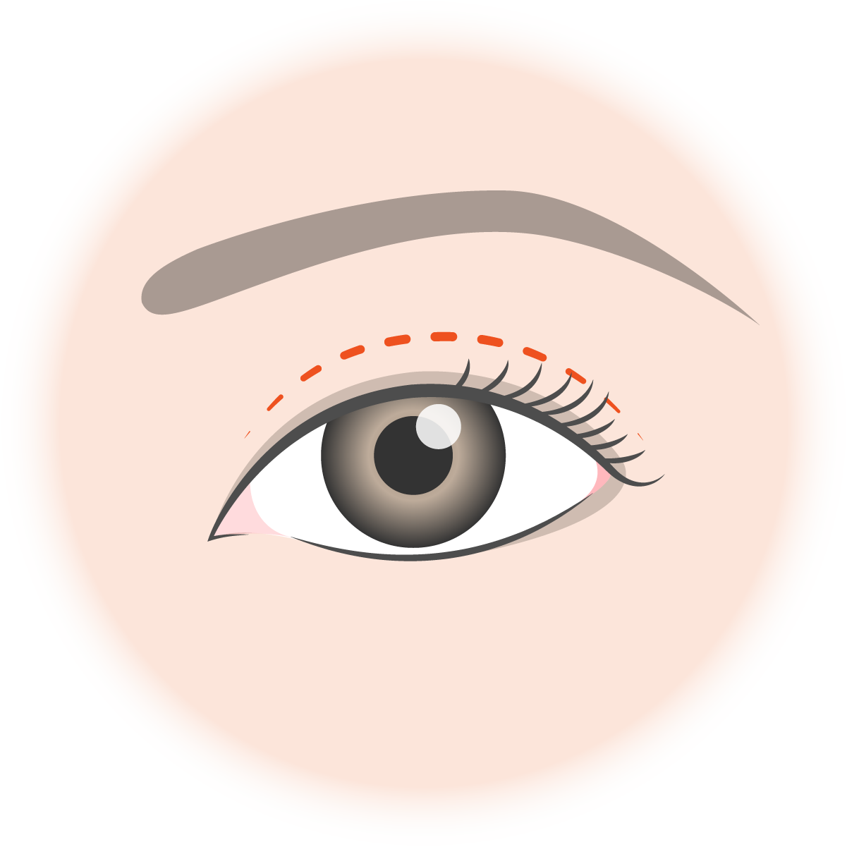 可佳医生聊整形之眼整形系列（一）——埋线法双眼皮 - 知乎